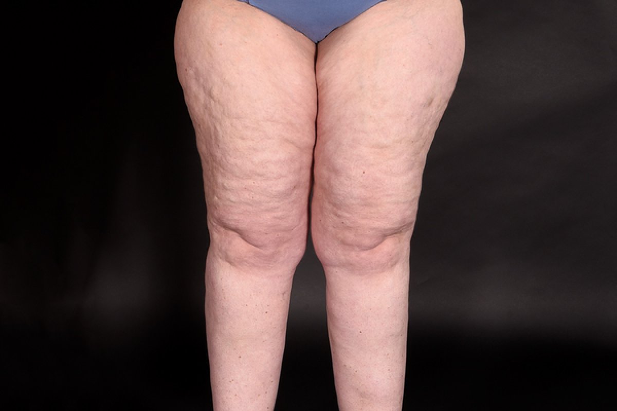 Lipödeme Beine: Ursachen und effektive Therapien